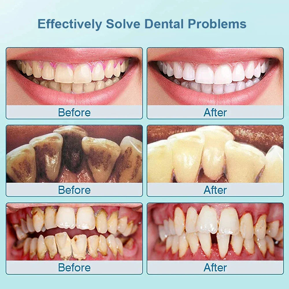 Ultrasone Tandrensare - SonicClean